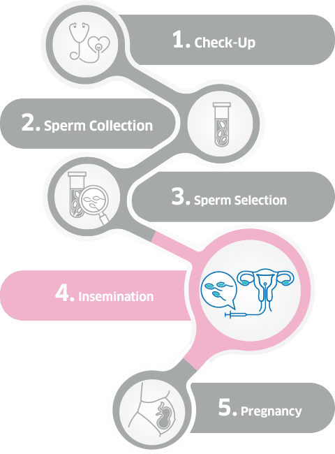 Intra-Uterine Insemination (IUI) process